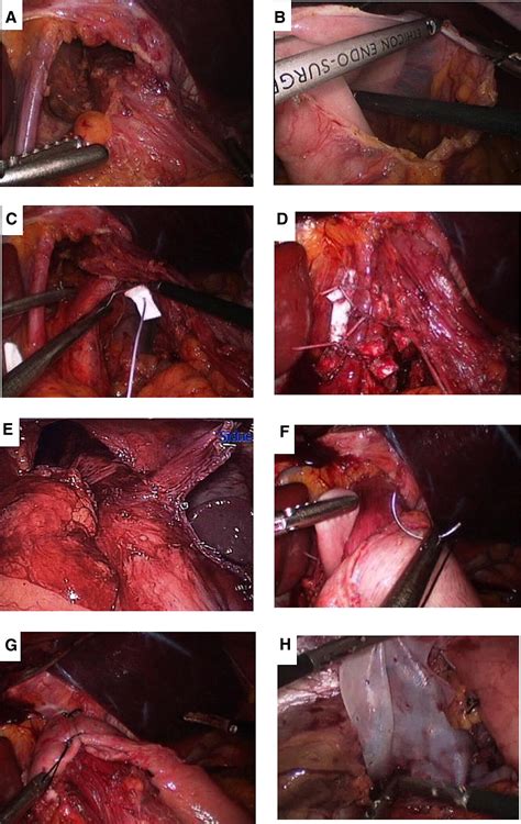 Giant Paraesophageal Hernia Repair Technical Pearls The Journal Of