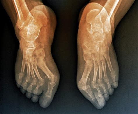 Rheumatoid Arthritis Of The Feet Photograph By Zephyrscience Photo