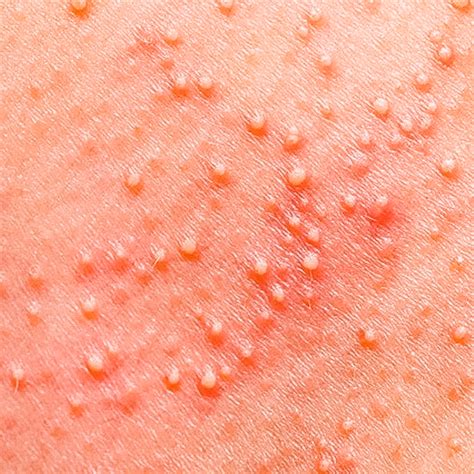 Keratosis Pilaris Price Skin Care