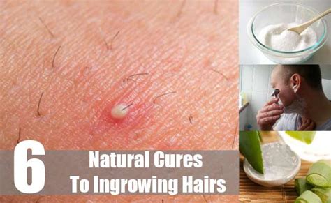 How To Get Rid Of Ingrown Hairs Best Herbal Health