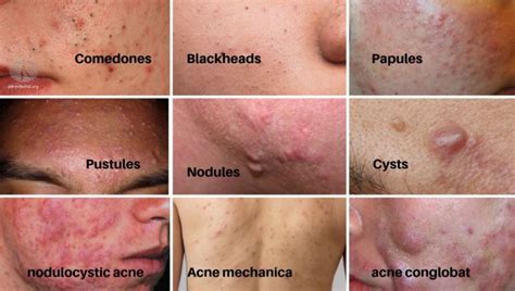 Know Your Type Of Acne