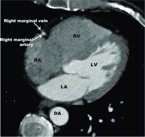 Right Marginal Vein Axial Ct Image Shows The Right Marginal Vein