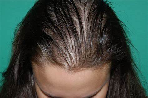 Front facing Hair Loss: Causes And How To Treat It