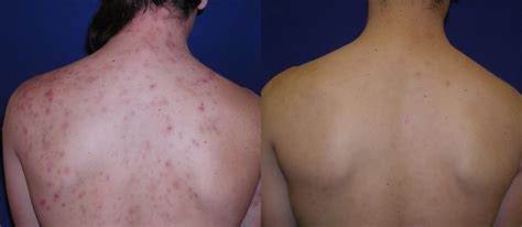 Acne Patient Before And After Gallery Advanced Skin Care Laser Body Contouring Center