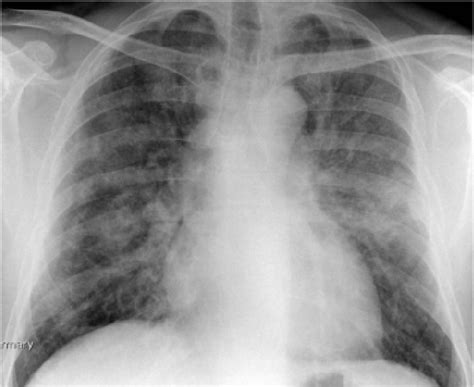 Case1 Chest X Ray Showing Diffuse Bilateral Lung Opacities Download