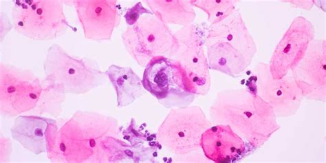 Possible Hpv Complications For High Risk Hpv Infections Blog