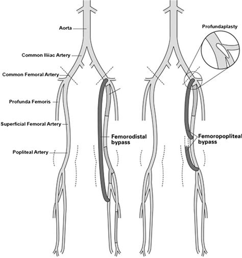 Surgical Intervention For Peripheral Arterial Disease Circulation
