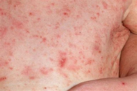 Scabies Pictures Rash Resource Scabies Rashes Scabies Rash