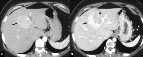 Contrast Enhanced Ct Scan In Arterial A And Venous B Phases Show An