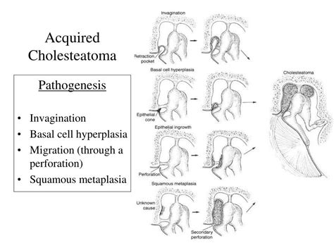 Ppt Chronic Otitis Media Com With And Without Cholesteatoma Pathophysiology Diagnosis And