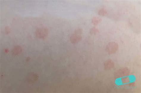 Itchy Rash Pictures 6 Most Common Cases And Their Treatment