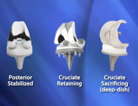 Types Of Total Knee Implants