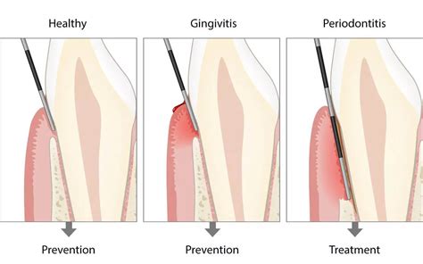 Basic Periodontal Examination Bpe News Dentagama