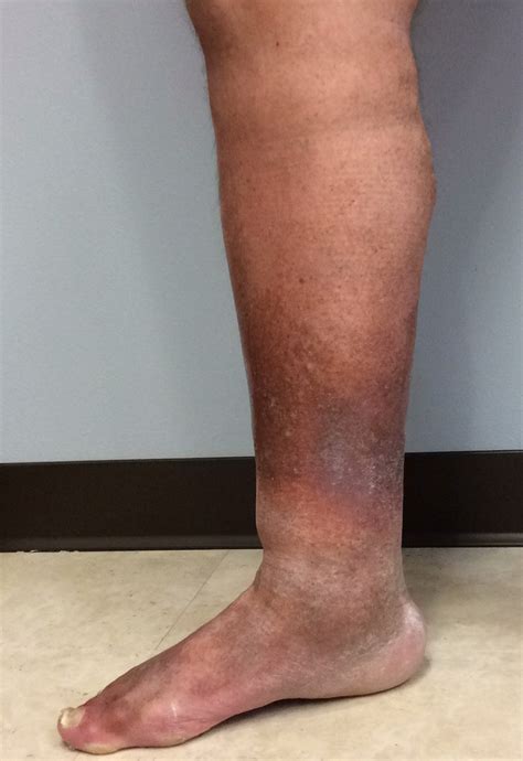 Venous Insufficiency Pictures Images A Visual Guide