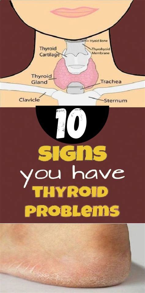 10 Signs You Have A Thyroid Problem And 10 Solutions For It Draco Beauty