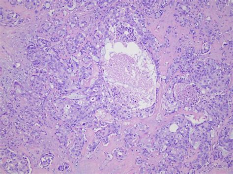 Pathology Outlines Salivary Duct Carcinoma