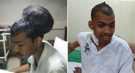 Doctors In India Remove The Worlds Largest Brain Tumor