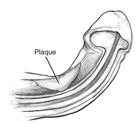 Cross Section Of A Curved Penis During With Label For Plaque