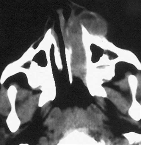 Case 3 Axial Ct Image Shows A Well Defined Lobulated Soft Tissue Mass