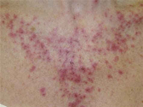 Efudex Chest 2 Skin Cancer Awareness Skin Center What Causes Rashes