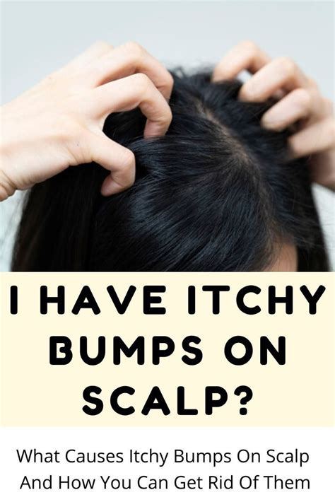 What Causes Itchy Bumps On Scalp And How You Can Get Rid Of Them In 2021 Cold Home Remedies
