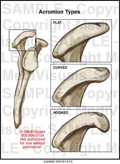 Acromion Types Medical Illustration Medivisuals