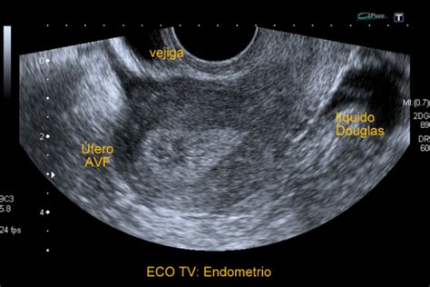 Endometriosis can affect women of any age. La endometriosis