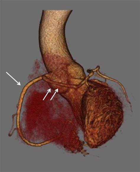 Anomalous Origin Of The Left Main Coronary Artery From The Right