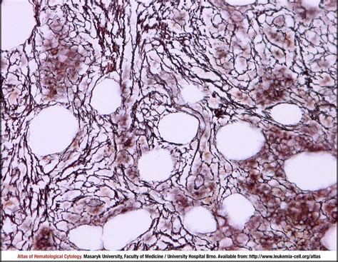 Overt Primary Myelofibrosis Cell Atlas Of Haematological Cytology