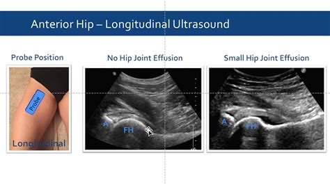 Anterior Hip Joint Ultrasound