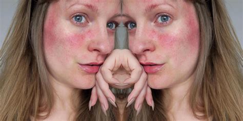 A Dermatologists Guide To Rosacea Imageie
