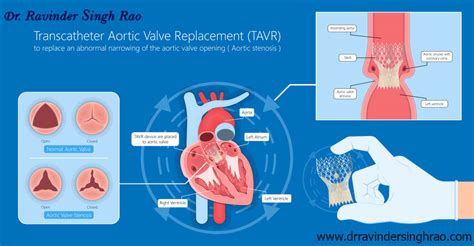 Transcatheter Mitral Valve Replacement Tmvr Expert In India
