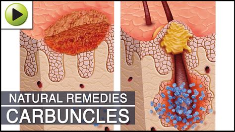 Home Remedies For Carbuncles