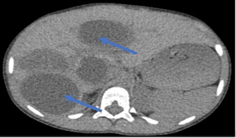 Cureus Cardiac Echinococcosis With Hepatic Involvement In A Child A