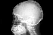 Osteoporosis, osteoclastic destructions, pathological fractures of the bone, spinal cord and compression can impair. Multiple myeloma | Radiology Reference Article ...