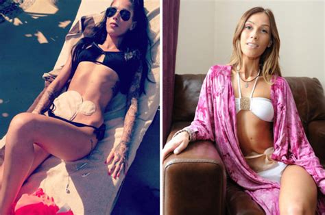 10 famous people with ostomies and colostomy bags. Crohn's disease sufferer posts bikini photo with her ...