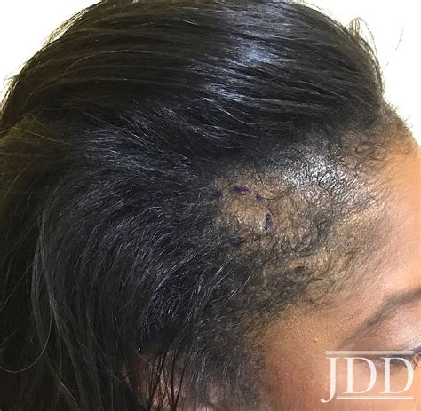 Frontal Fibrosing Alopecia Presenting As Androgenetic Alopecia In An
