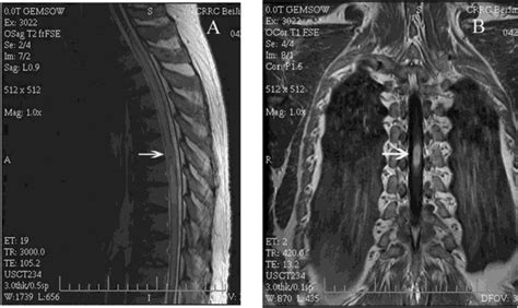 Lesions On Mri T Spine