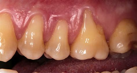 Gum Graft Before And After Pictures Md Periodontics Los Angeles