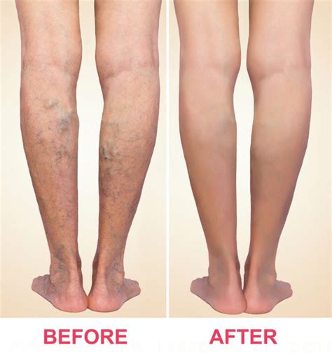 Varicose Veins Treatments Fort Myers Bonita Springs