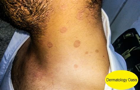 I answer your questions about a common skin condition called pityriasis versicolor & skin care products to get rid of it!shampoos, cleansers. Hyperpigmented pityriasis versicolor | Dermatology Oasis