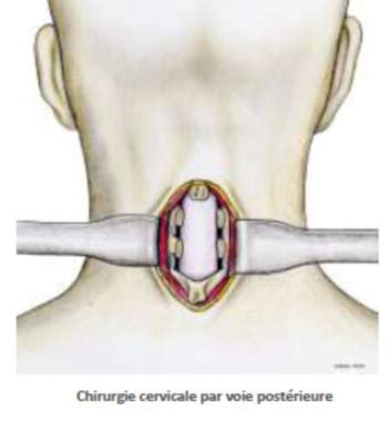 Canal cervical étroit Chirurgie Orthopédique