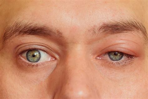 Swollen Eyelid Causes Treatments Remedies Shekar Eye Hospital