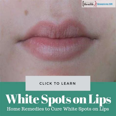 White Spots On Lips