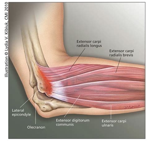 Tennis Elbow I Am Getting An Injection Get Well Physical Therapy