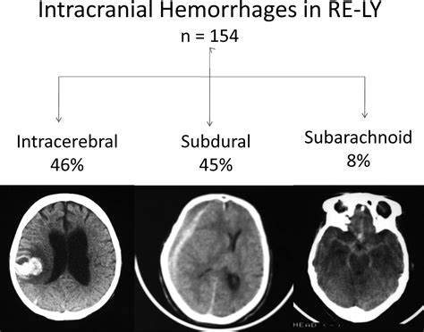 Intracranial Hemorrhage Cause Symptoms Diagnosis Treatment