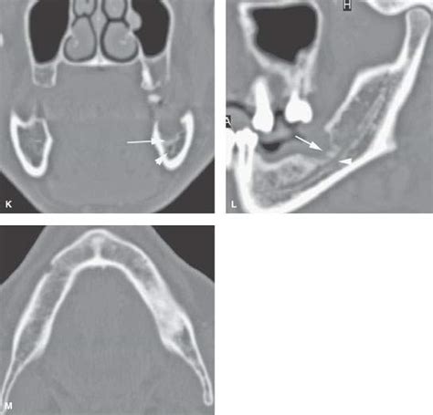 Oral Cavity And Floor Of The Mouth Malignant Tumors Radiology Key