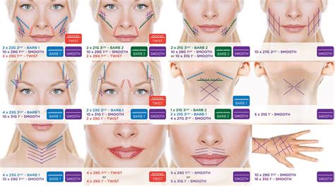 Thread Facelift ① Nyc Botox Juvederm Dysport Ultherapy Facial