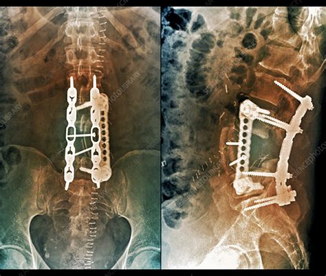 Implants Following Spinal Surgery X Rays Stock Image C0370742