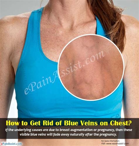 How To Get Rid Of Visible Veins On Legs